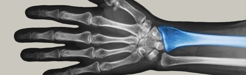 Illustration of a Distal Radius Fracture