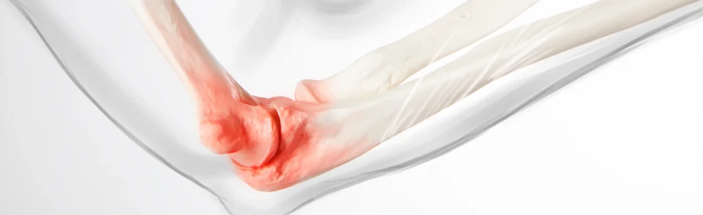Illustration of elbow arthritis