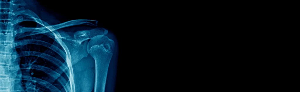 Xray of Clavical Fracture aginst dark background